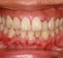 Otečene desni, ali zub ne boli - šta da radim? Uzrokuje oticanje desni i liječenje