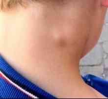 Otok na vratu: uzroci, simptomi, vrste i karakteristike tretmana