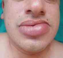 Otečene usne: četiri razloga za bolest