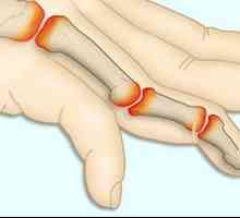 Glavni simptomi reumatoidnog artritisa