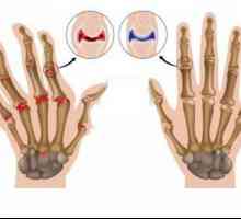 Karakteristike stanja i liječenje bolesnika s reumatoidnim artritisom