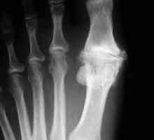 Osteoartritisa stopala: uzroci, simptomi i metode tretiranja