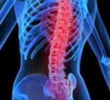 Spinalne osteofiti. Osteofiti vratne kralježnice