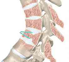 Osteohondroza od lumbalne kičme: simptomi i tretman. Vježba, masaža, akupunktura