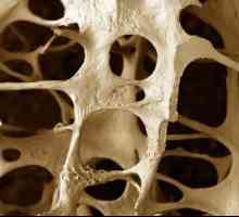 Osteopenija - šta je to i šta su tretmani