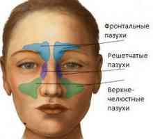 Akutni sinusitis: simptomi. Liječenje akutnog sinusitisa