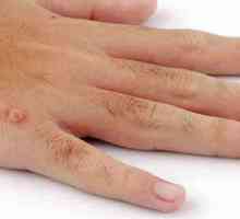 Od kojih su bradavice na rukama? Šta uzrokuje bradavice na prstima djece?