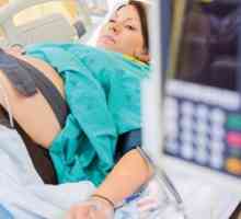 Odstupanja od norme "D-dimer" tokom trudnoće