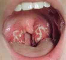 Gdje radi aureus u grlu. simptomi infekcije