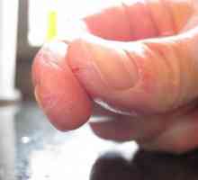 Fingers crack: uzroci i tretman