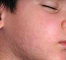 Mumps kod djece. Simptomi i liječenje bolesti