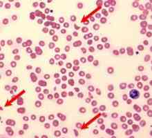 Patološki hemolize krvi: uzroci, simptomi i tretmani
