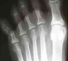 Preloma prstiju: uzroci, simptomi i tretmani