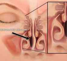 Perforacije nosne pregrade: uzroci, simptomi, tretmani i efekti