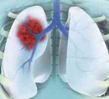 Periferne raka pluća: faza, liječenje, medicinsku istoriju. Periferne pluća udio raka