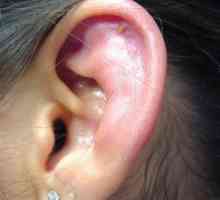 Perichondrium uha: simptomi, liječenje, fotografije