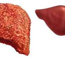 Primarni simptomi tseyroza jetre