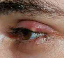 Pisyak na oku: simptomi, liječenje, prevencija