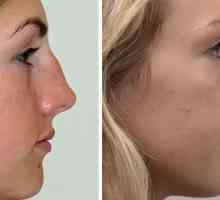 Plastičnu operaciju nosa fotografija, recenzije