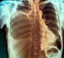 Pleuritis od raka pluća: opis uzroka, simptomi i liječenje