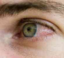Zašto crvene oči, i kako eliminirati nelagodu?