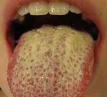 Zašto žuta jezik? Kakav bolesti ukazuje na njegovo stanje?