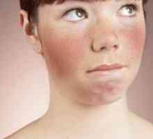 Zašto crveno lice: uzroci i tretman