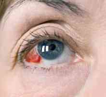 Zašto upala krvnih sudova u očima: uzroci i tretman