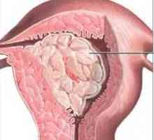 Endometrija polip, šta je to? Uzroci, Simptomi i metode tretiranja