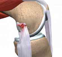 Torn ligamenata u nogu: Simptomi i tretman