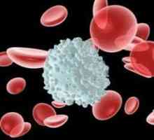Povećana limfocita u krvi: razloga nije razjašnjena