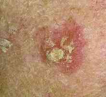 Koji bolesti krljuštima flaster na koži?