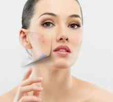 Uzrok Interna bubuljice na licu. Kako ukloniti unutrašnje akni na licu?