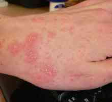 Uzroci alergije na sunce i njene metode liječenja