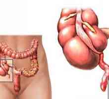 Uzroci i simptomi hroničnog apendicitis