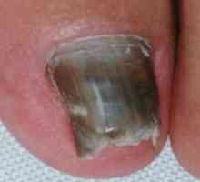 Uzroka simptoma i liječenje noktiju onihomikoza