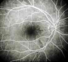 Uzroci, simptomi i tretman retine angiopatija