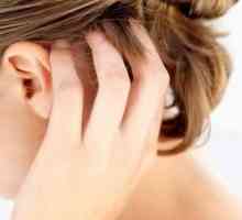 Uzroci, simptomi i liječenje seboroični dermatitis na glavi
