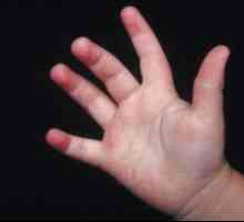 Znak bilo koje bolesti je osip na nogama i rukama djeteta