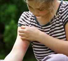 Prevenciju i liječenje komaraca ugrize kod djece