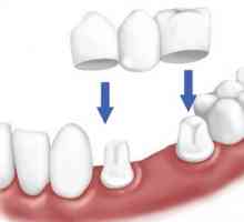 Proteza, u nedostatku velikog broja zuba: Vrste