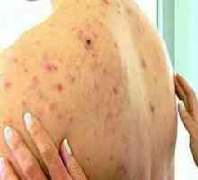 Bubuljice na leđima i ramenima: uzroci i liječenje