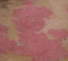 Psorijaza je zarazna ili ne - kako tretirati osobu sa sličnim manifestacijama na koži