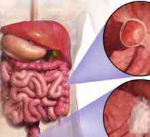 Raka crijeva žive mnogo? Prognoza: koliko je ostalo da živi
