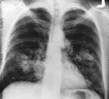 Rak pluća: Koliko žive? Treba da vjerujem prognozama?
