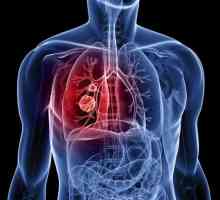 Planocelularni karcinom pluća: opis, uzroci, dijagnoza i liječenje funkcije