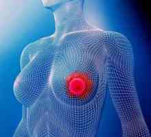 Rak dojke, Korak 2a: prognoza. raka dojke fazi 2a tretira?