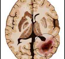 Mozak Rak: Uzroci, Simptomi i dijagnoza