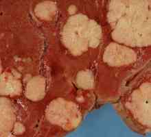 Raka jetre: znakova bolesti i sve što trebate znati o tome