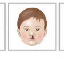 Rascjep usne i nepca: uzrok i korekcija